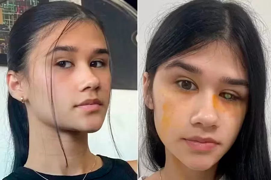 Mulher fica cega de um olho pelo mau uso da lente de contato e faz alerta na internet 