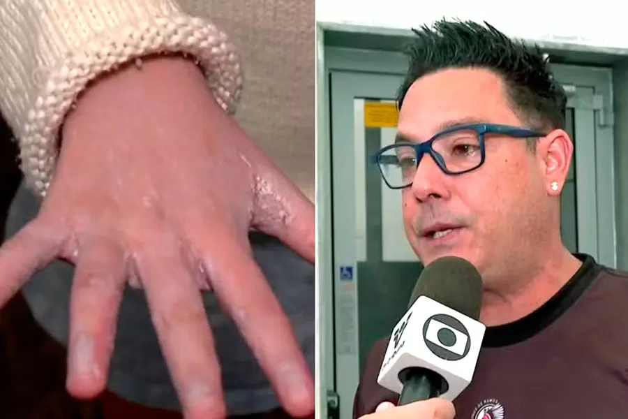 Filhos de cantor Vavá pegam sarna em escola com surto de casos; entenda a doença